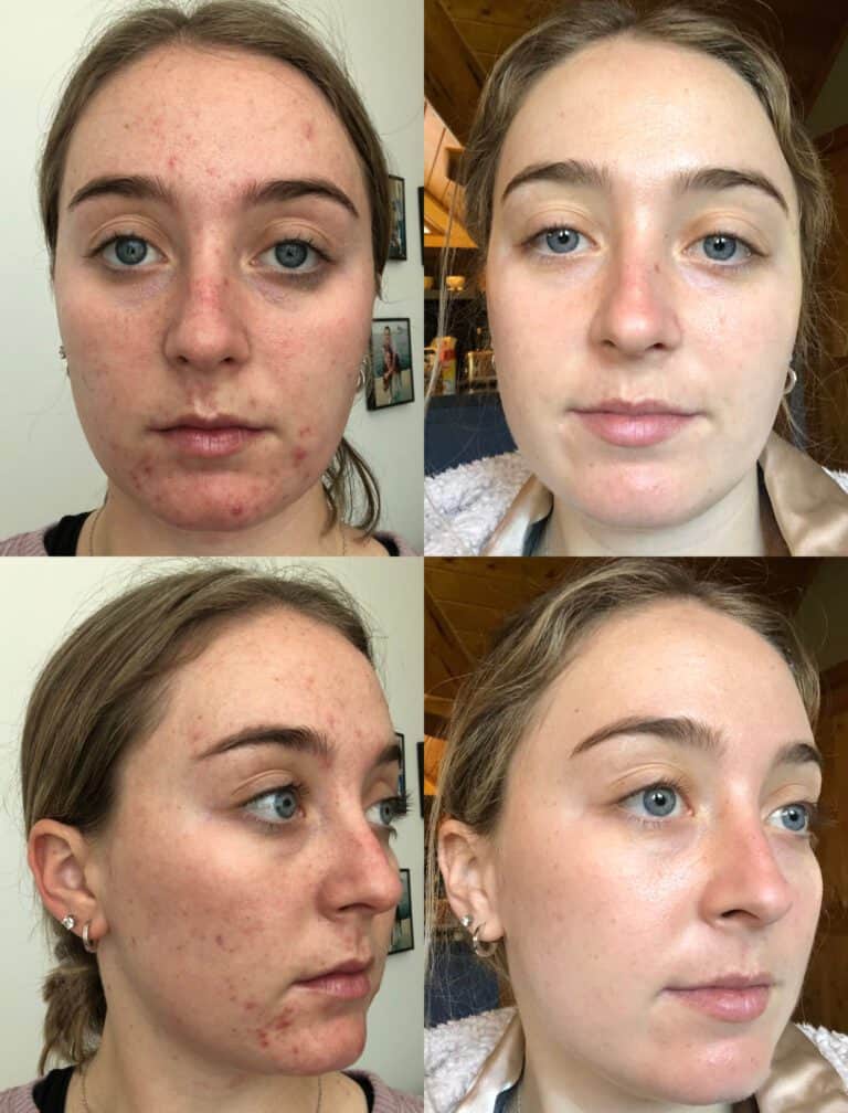 My Accutane Experience: Results After 5 Months of Isotretinoin